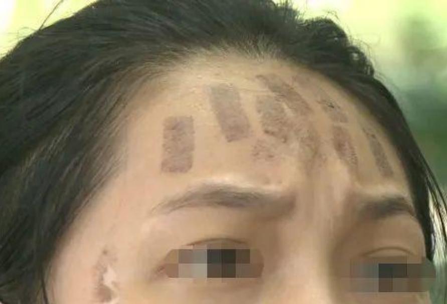 成都光子嫩膚價(jià)格，科技重塑肌膚之美